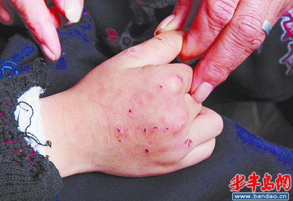 鲁博城不高兴时会抓自己的小手，抓出了不少伤痕